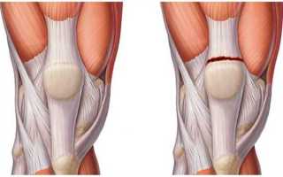 Как лечить растяжение связок колена