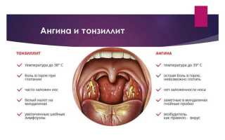 О чем сигнализирует гной в горле?