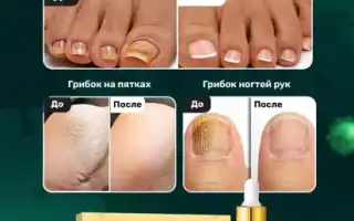 Лечение грибка стопы и ногтей