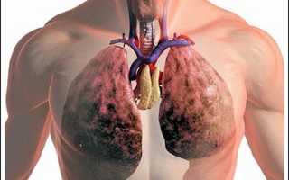 Воспаление легких: симптомы, лечение и опасности болезни