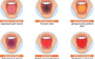 Чем опасен черный налет на языке