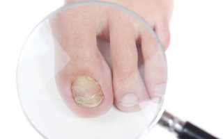 Вылечить грибок на ногтях ног