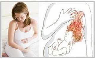 Лечение изжоги при беременности