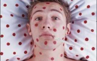 Как быстро и эффективно лечиться от ветрянки?