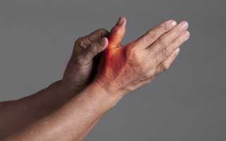 Болит большой палец на руке, что делать