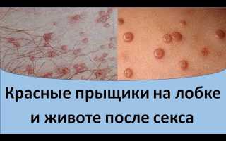 Что вызывает сыпь на лобке и как ее лечить: причины и советы