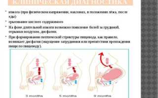 Как лечить изжогу в период беременности