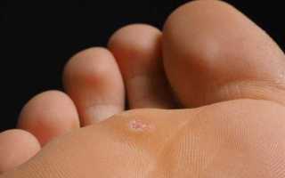 Как лечить бородавки на руках