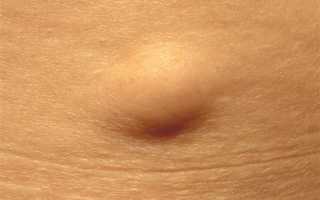 Что такое подкожные жировики