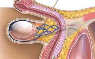 Что такое варикоцеле