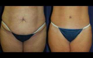 Спорт после кесарева сечения