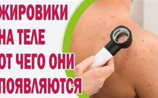 Как лечить жировики в домашних условиях