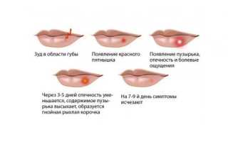 Как быстро вылечить герпес на губах