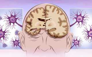 Отмирание клеток головного мозга