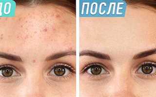 Искусственные способы устранения прыщей с использованием доступных материалов из домашних запасов