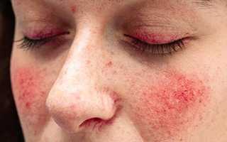 Причины появления красных пятен на лице и как с ними бороться