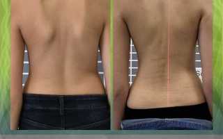 Методы и советы для успешного лечения сколиоза 1 степени