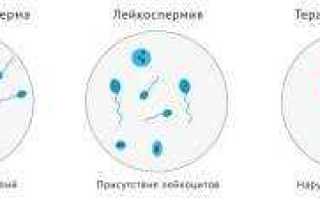 Лейкоциты в сперме: причины, последствия и методы лечения