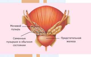 Как лечить везикулит