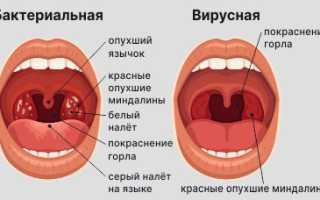 Чем лечить гнойную ангину у ребенка