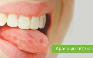 Что означают пятна на языке