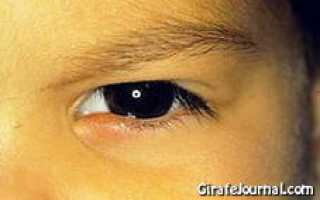 Как лечить ячмень