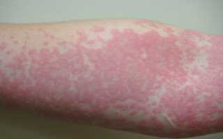 Аллергические заболевания кожи