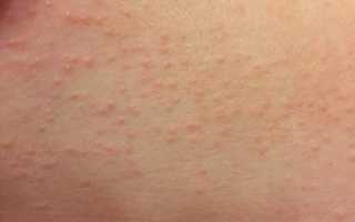 Чем лечить потницу