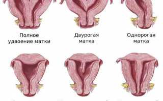 Седловидная матка – что это такое