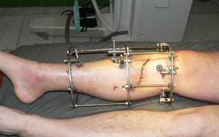 Как лечится перелом ноги