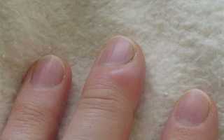 Как лечить паронихию