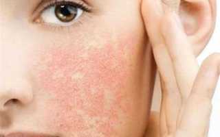 Как лечить аллергию на лице