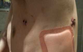 Наложение окклюзионной повязки при открытом пневмотораксе