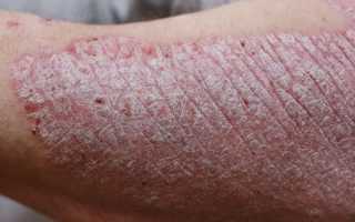 Как вылечить кошачий лишай у людей