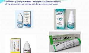 Чем лечить коньюктивит