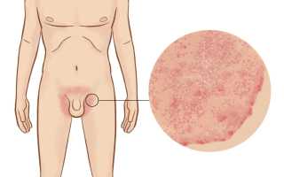 Зуд и покраснение в области паха, о чем это говорит