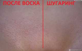 Как избавиться от раздражения в зоне бикини