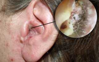 Грибковые заболевания ушей: полное руководство для пациентов