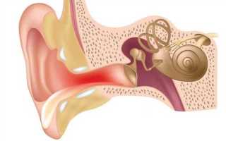 Как лечить воспаление среднего уха