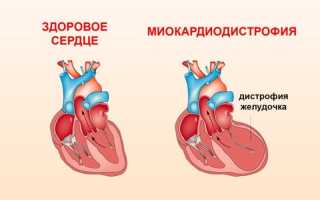 Миокардиодистрофия у детей