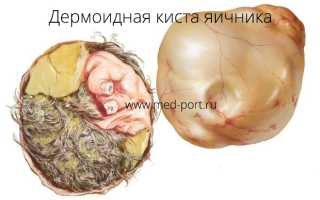 Что такое дермоидная киста яичника
