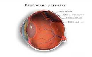 Эффективные методы лечения отслоения сетчатки глаза
