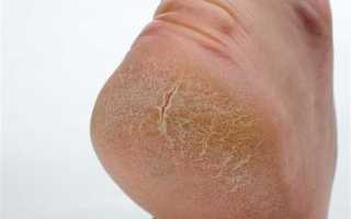 Женские грибковые заболевания