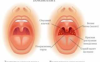 Лечение болезней горла и миндалин