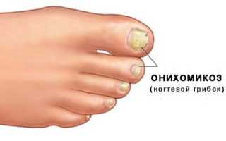 Способы и методы лечения грибка на ногтях: эффективные народные средства и консервативные методы