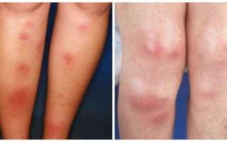 Лечение узловатой эритемы: эффективные методы и рекомендации