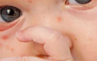 Что надо знать о ветрянке у детей