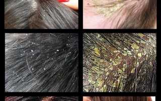 Как избавиться от перхоти быстро