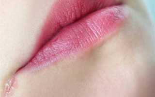 Как лечить заеды в уголках рта