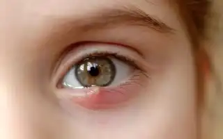 Как лечить ячмень на глазе